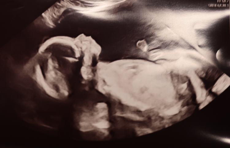 👼🏽The Second Anatomy Scan: A Peek Into Baby’s World & The Science Behind the Screen